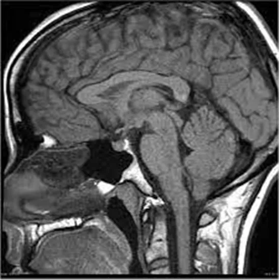 MRI Pituitary
